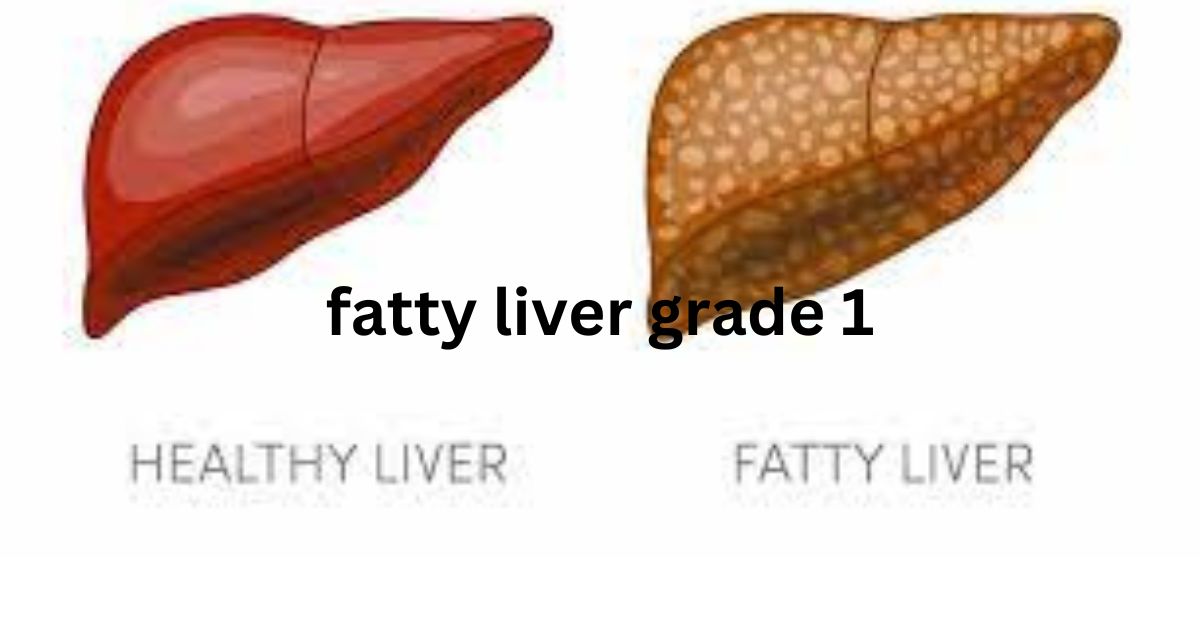 Fatty Liver Grade 1