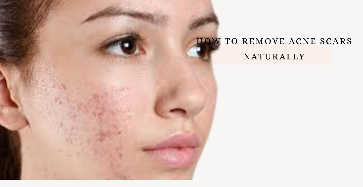 How to Remove Acne Scars Naturally