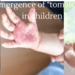 Emergence of "tomato flu" in children